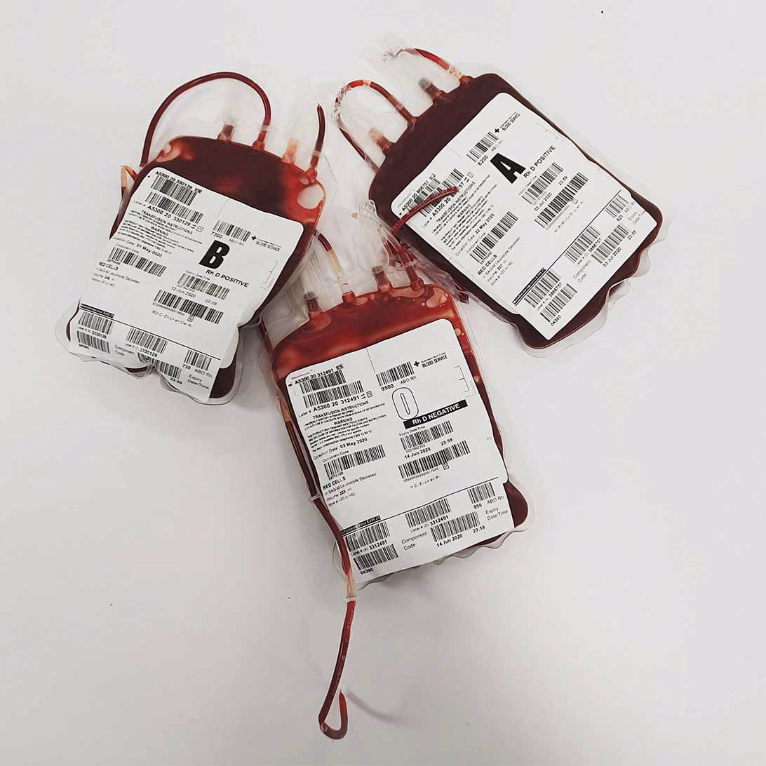 Blood bags for transfusion for patients with sickle cell anemia